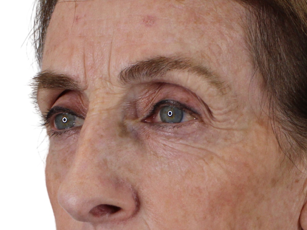 Blepharoplasty Before & After Gallery - Patient 148519228 - Image 3