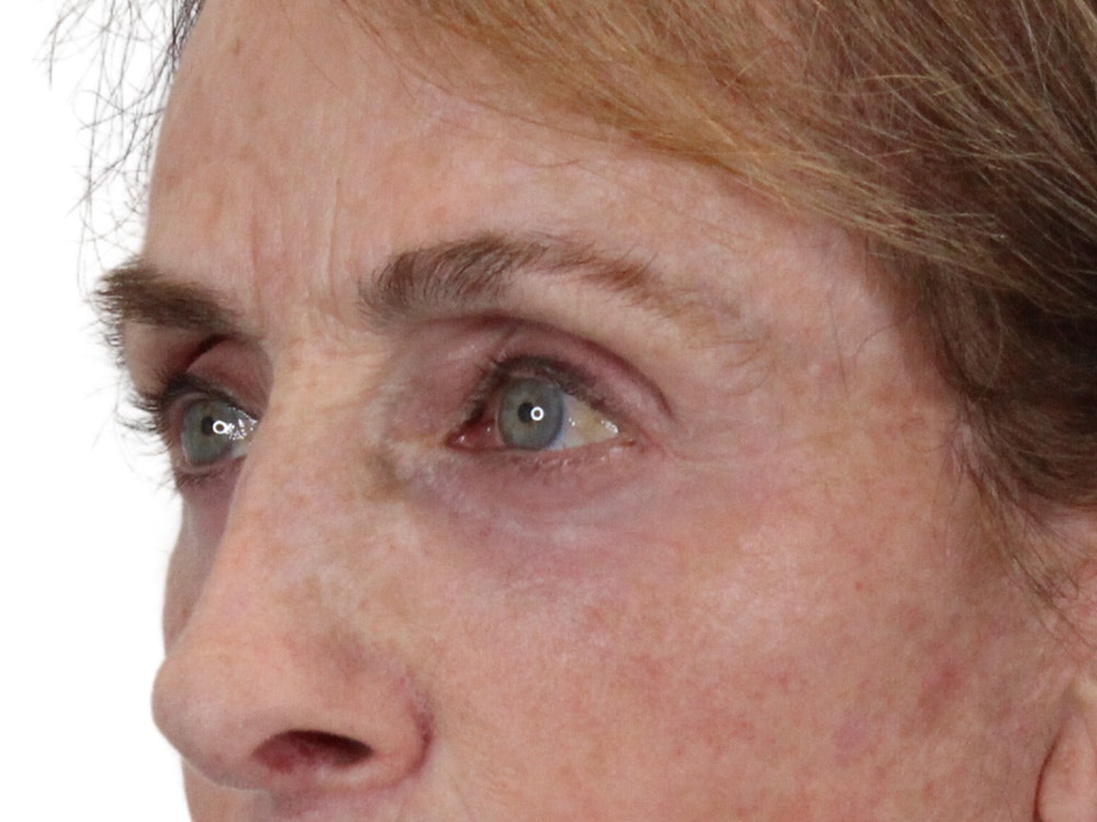 Blepharoplasty Before & After Gallery - Patient 148519228 - Image 4