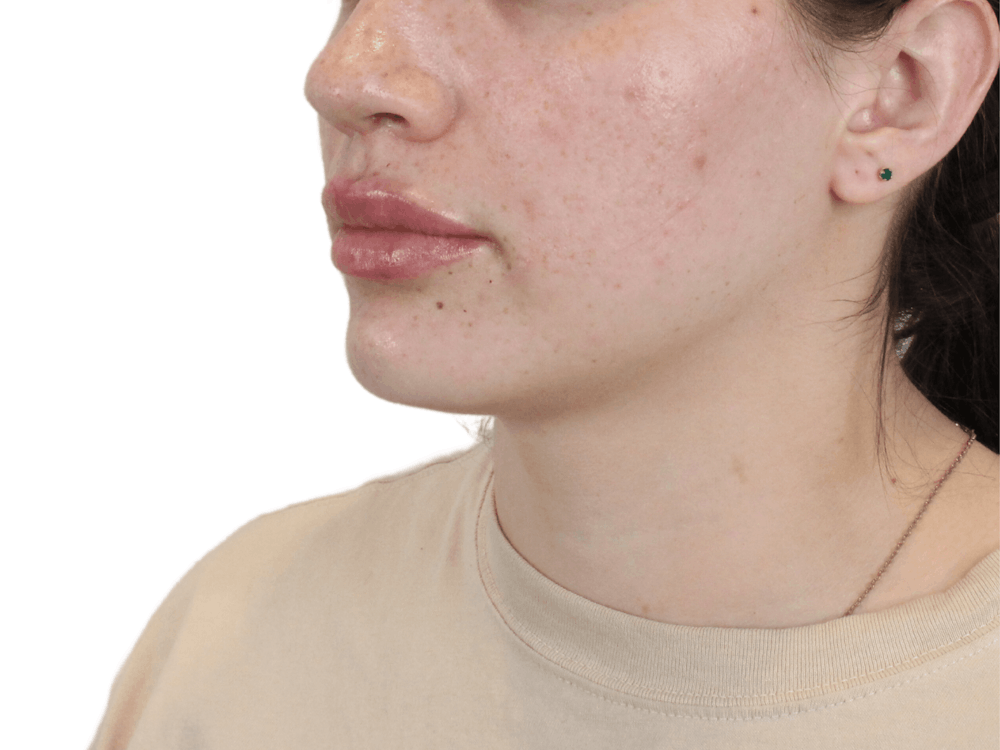 Lip Filler Before & After Gallery - Patient 149233771 - Image 2