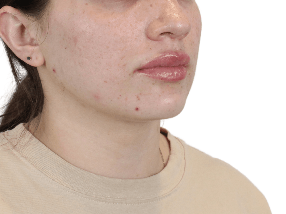 Lip Filler Before & After Gallery - Patient 149233771 - Image 4