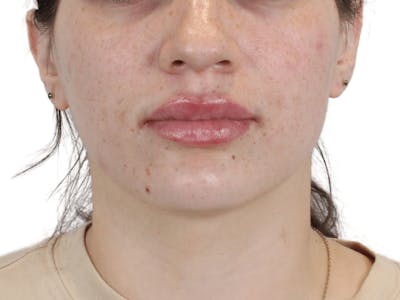 Lip Filler Before & After Gallery - Patient 149233771 - Image 6