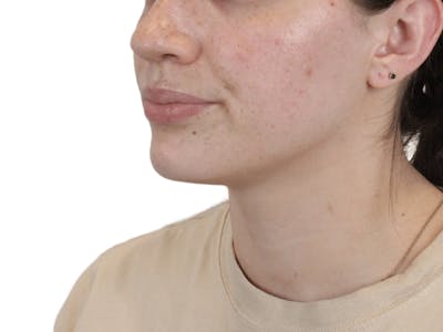 Lip Filler Before & After Gallery - Patient 149233771 - Image 1