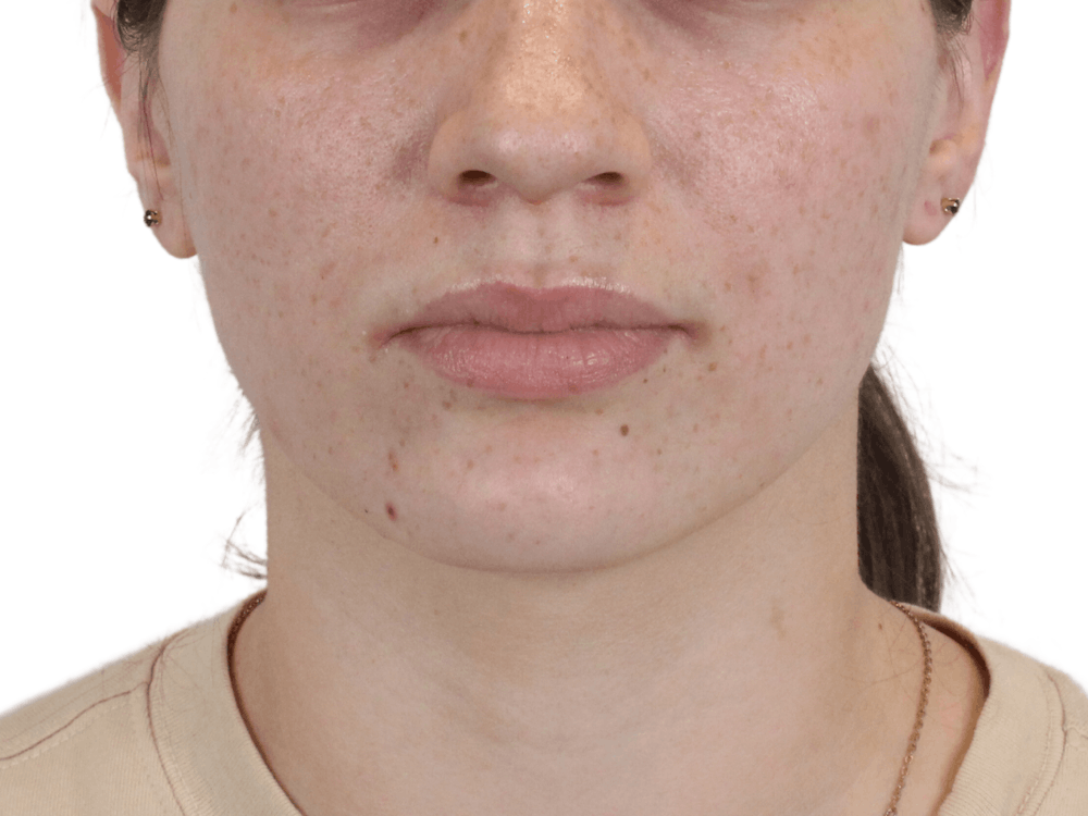 Lip Filler Before & After Gallery - Patient 149233771 - Image 5