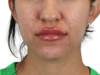 Lip Filler Before & After Gallery - Patient 149233772 - Image 2