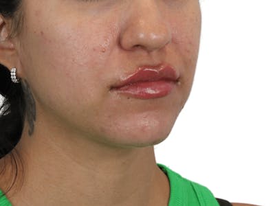 Lip Filler Before & After Gallery - Patient 149233772 - Image 4