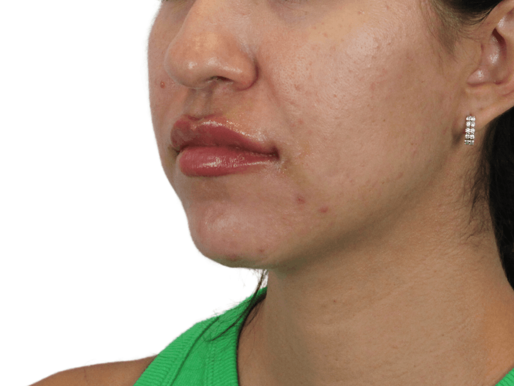 Lip Filler Before & After Gallery - Patient 149233772 - Image 6