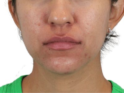 Lip Filler Before & After Gallery - Patient 149233772 - Image 1