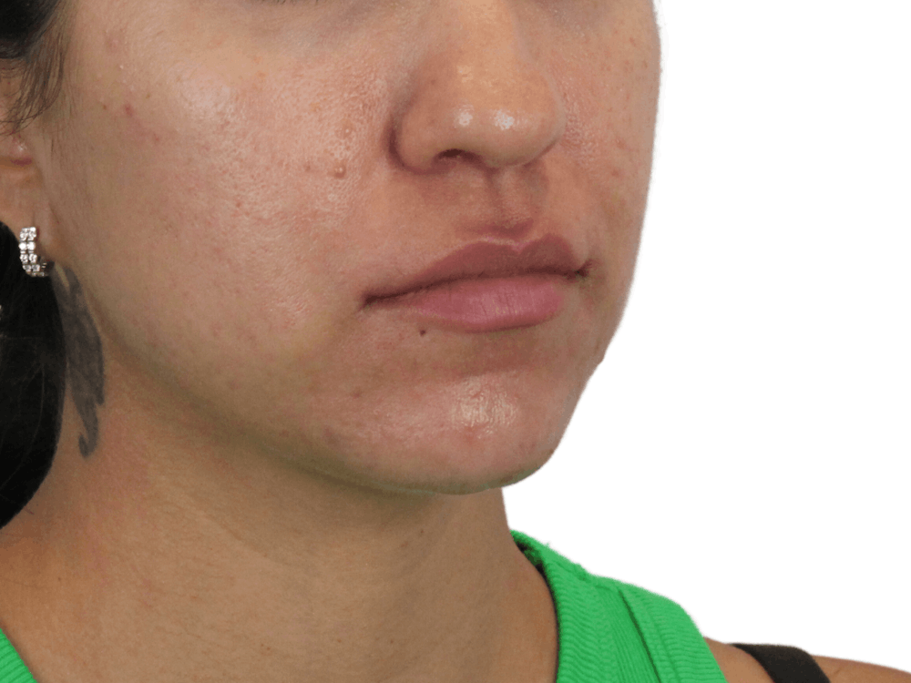 Lip Filler Before & After Gallery - Patient 149233772 - Image 3