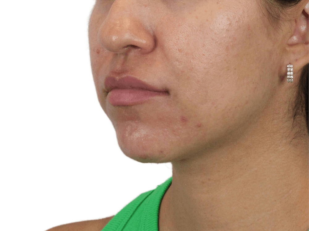 Lip Filler Before & After Gallery - Patient 149233772 - Image 5