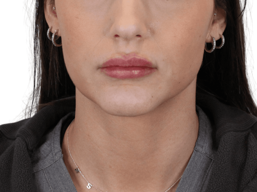 Lip Filler Before & After Gallery - Patient 149233773 - Image 2