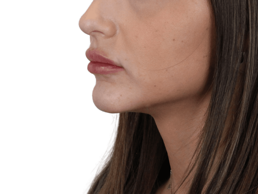 Lip Filler Before & After Gallery - Patient 149233773 - Image 4