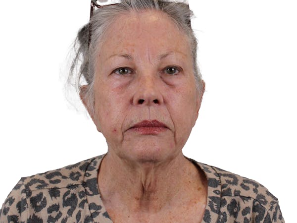 AdmireMD Deep Plane Face & Neck Lift ● Upper & Lower Blepharoplasty ● Fat Transfer to Tear Troughs