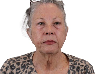 Deep Plane Facelift Before & After Gallery - Patient 155735069 - Image 1