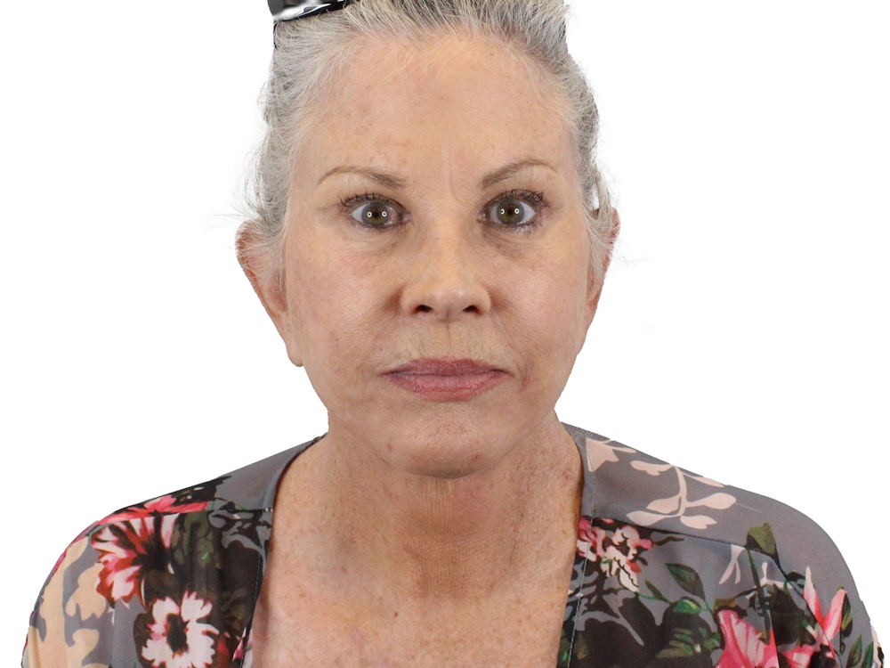 Deep Plane Facelift Before & After Gallery - Patient 155735069 - Image 2