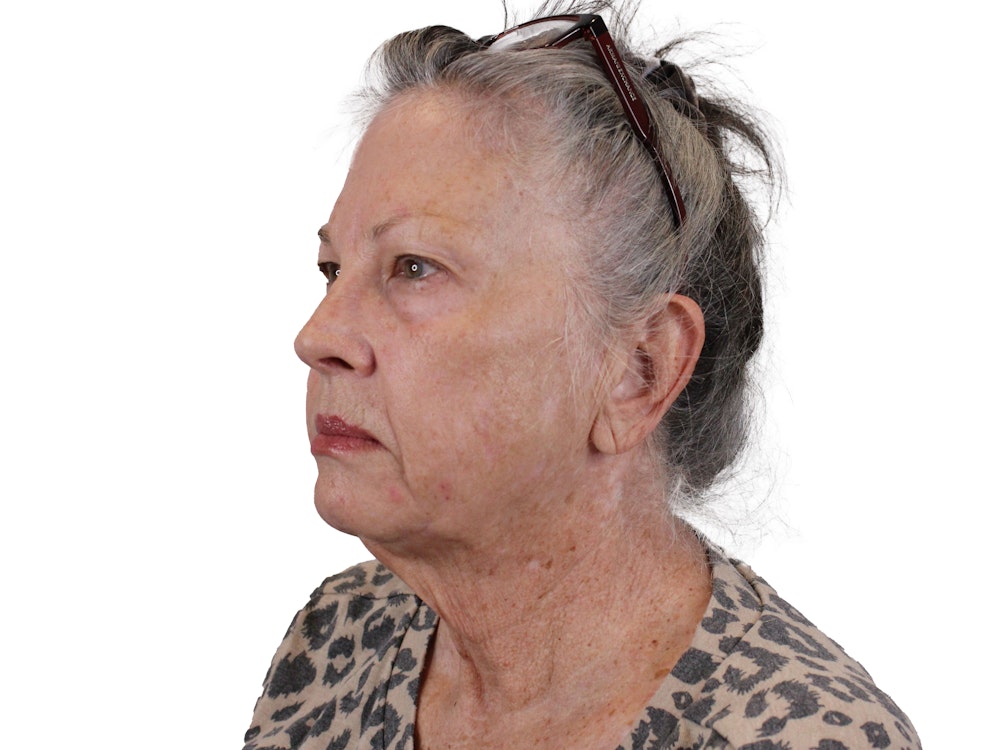 Deep Plane Facelift Before & After Gallery - Patient 155735069 - Image 3