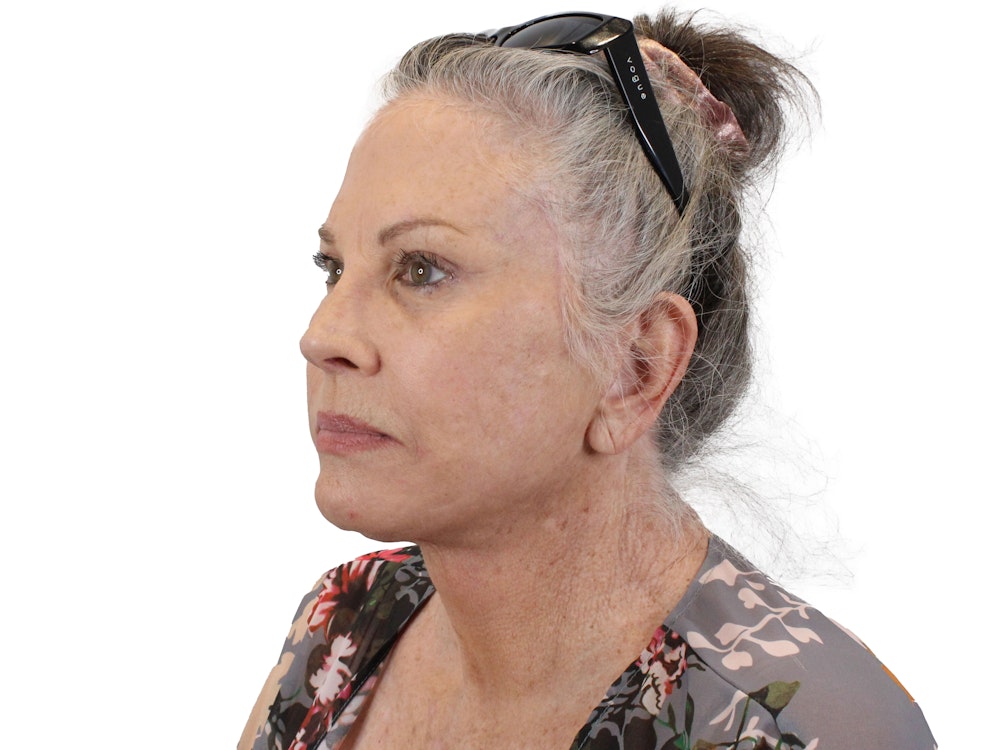 Deep Plane Facelift Before & After Gallery - Patient 155735069 - Image 4