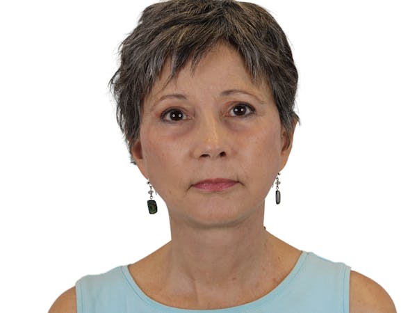 AdmireMD Deep Plane Face & Neck Lift ● Laser Resurfacing to Periorbital Area