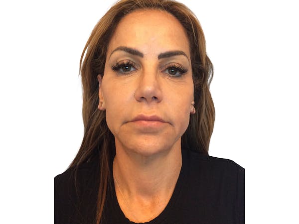 AdmireMD Deep Plane Face & Neck Lift ● Upper Blepharoplasty