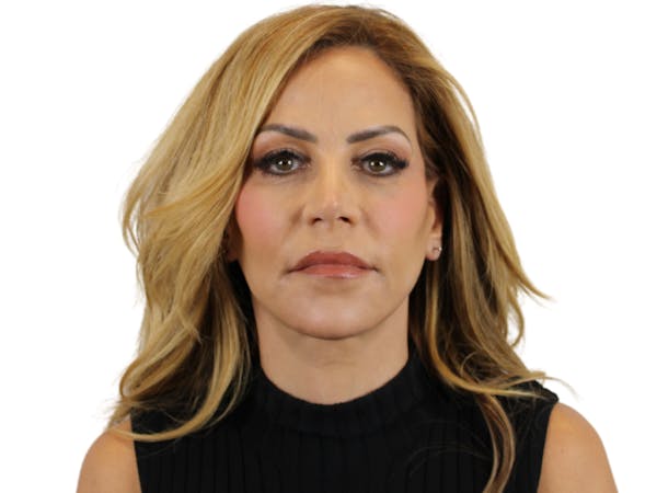 AdmireMD Deep Plane Face & Neck Lift ● Upper Blepharoplasty