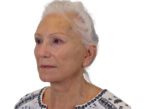 AdmireMD Deep Plane Face & Neck Lift ● Upper & Lower Blepharoplasty