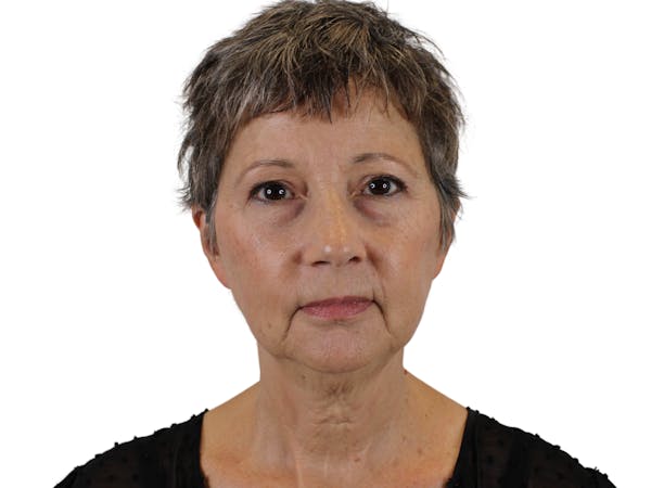 AdmireMD Deep Plane Face & Neck Lift ● Laser Resurfacing to Periorbital Area