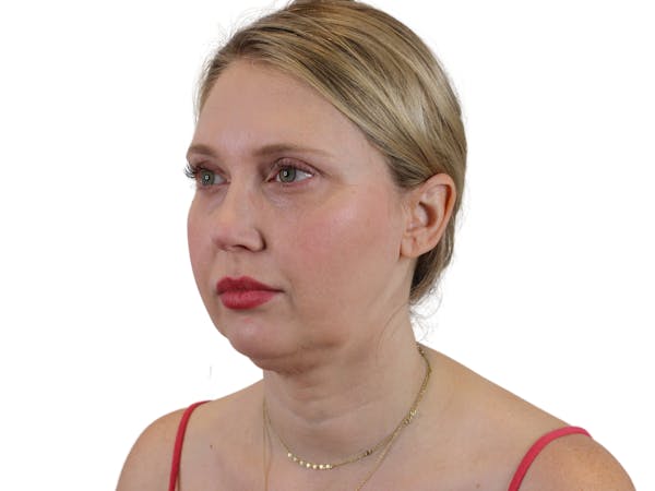 AdmireMD Deep Plane Face & Neck Lift