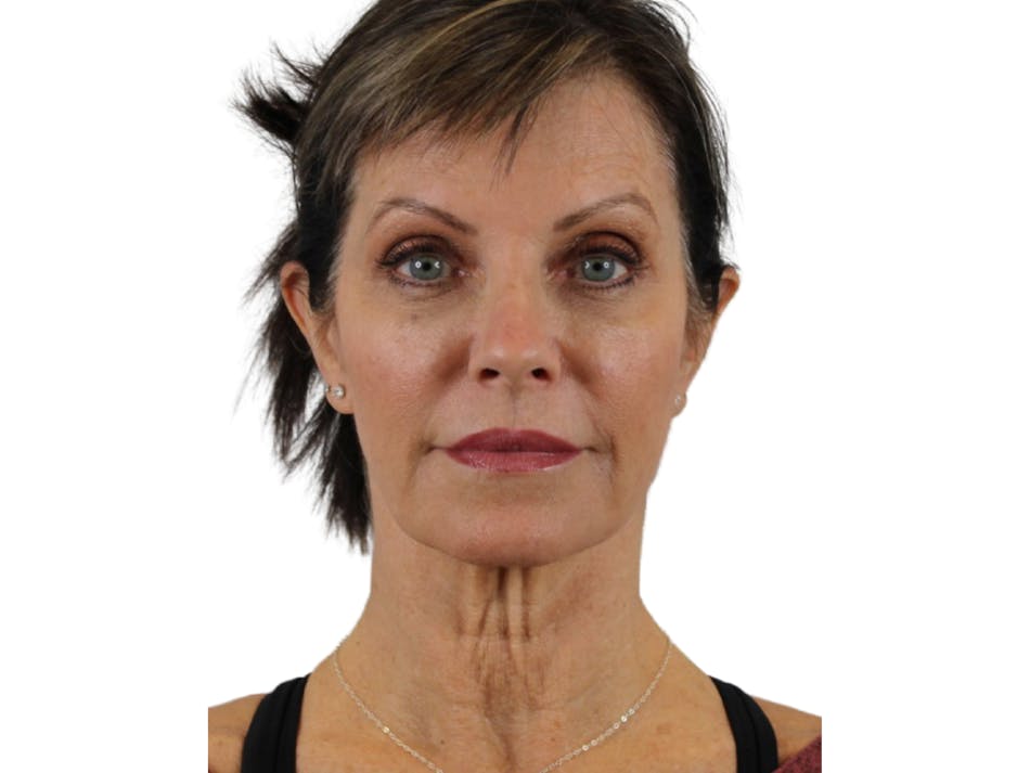 AdmireMD Deep Plane Face & Neck Lift ● Fat Transfer to Tear Troughs