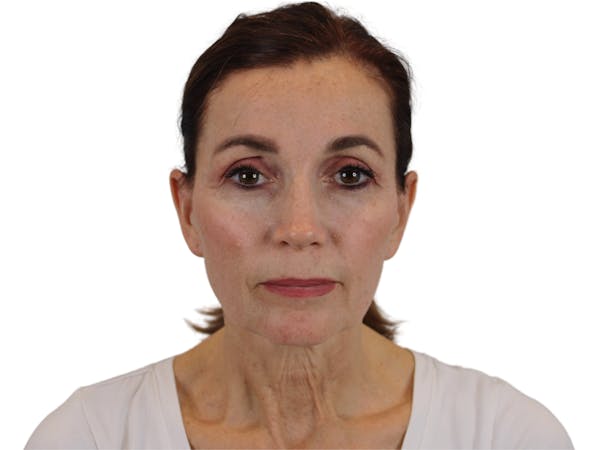 AdmireMD Deep Plane Face & Neck Lift