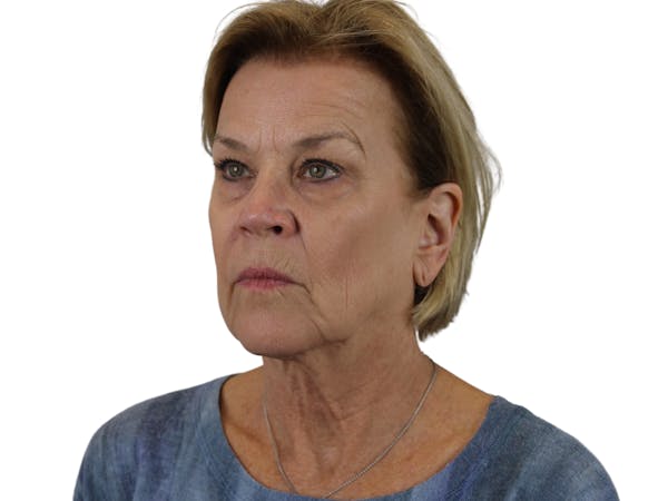 AdmireMD Deep Plane Face & Neck Lift ● Upper & Lower Blepharoplasty ● Laser Resurfacing to Periorbital Area