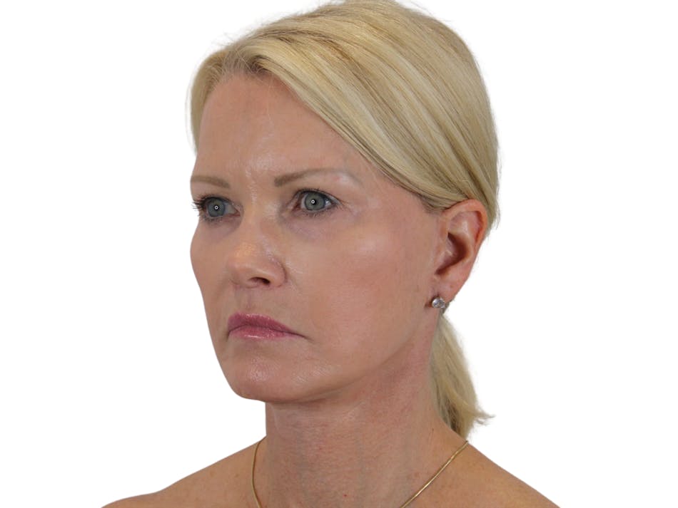 Deep Plane Face & Neck Lift ● Lip Lift ● Laser Resurfacing to Periorbital Area