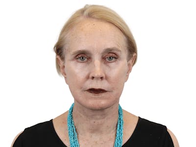 Deep Plane Facelift Before & After Gallery - Patient 157358257 - Image 2
