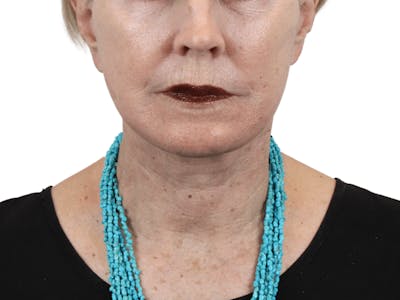 Deep Neck Lift Before & After Gallery - Patient 157358271 - Image 2