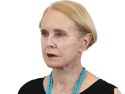Deep Plane Facelift Before & After Gallery - Patient 157358257 - Image 6
