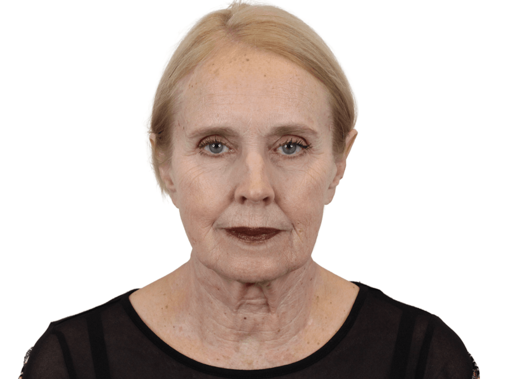 Deep Plane Facelift Before & After Gallery - Patient 157358257 - Image 1