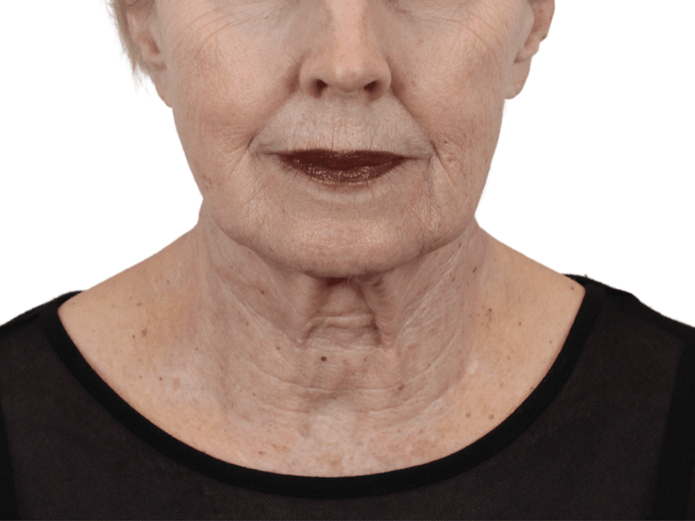 Deep Plane Facelift Before & After Gallery - Patient 157358257 - Image 3