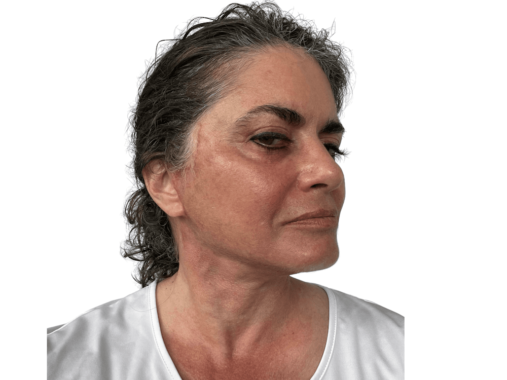 Deep Plane Facelift Before & After Gallery - Patient 157358258 - Image 4