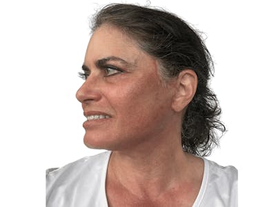 Deep Plane Facelift Before & After Gallery - Patient 157358258 - Image 6
