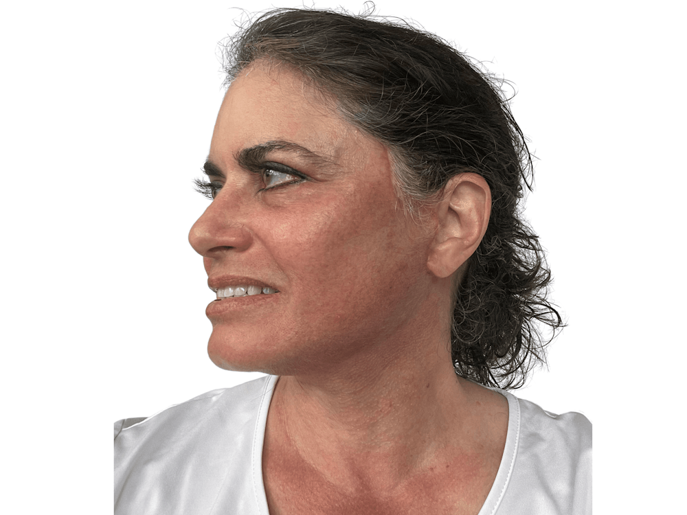 Deep Plane Facelift Before & After Gallery - Patient 157358258 - Image 6