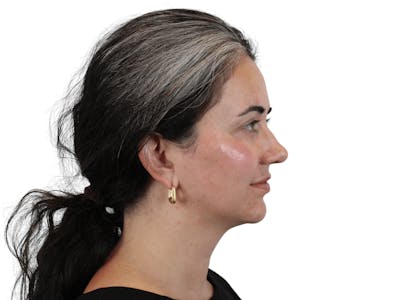 Chin Filler Before & After Gallery - Patient 159271051 - Image 2