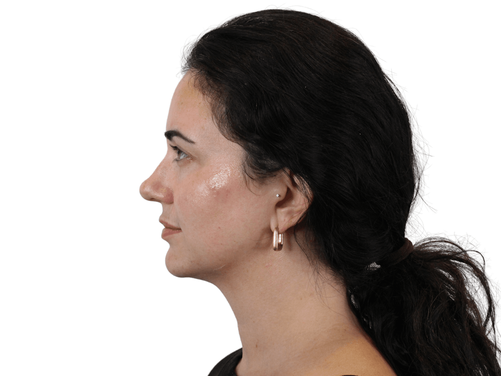 Cheek Filler  Before & After Gallery - Patient 159270998 - Image 10