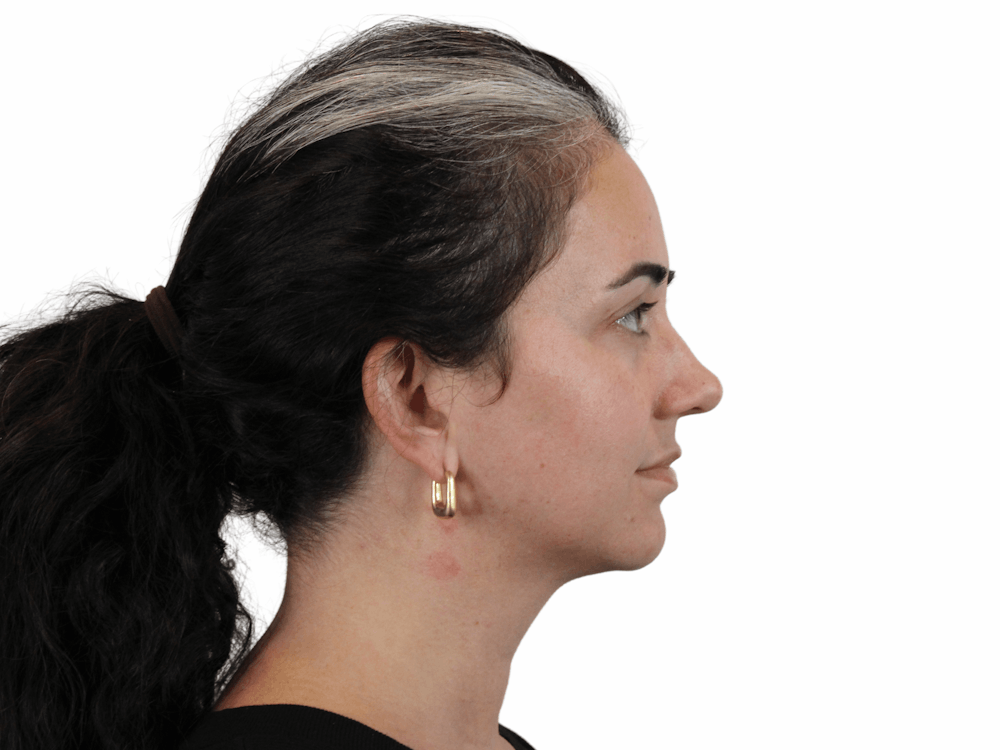 Chin Filler Before & After Gallery - Patient 159271051 - Image 1