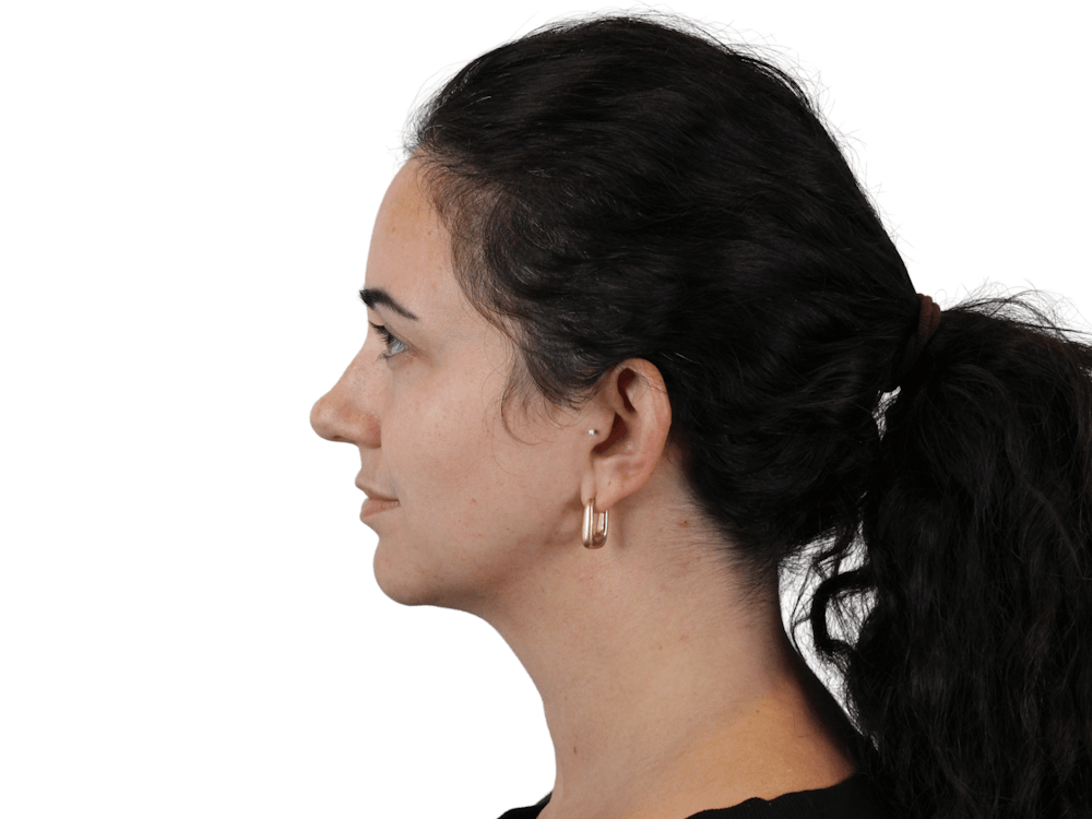 Chin Filler Before & After Gallery - Patient 159271051 - Image 9