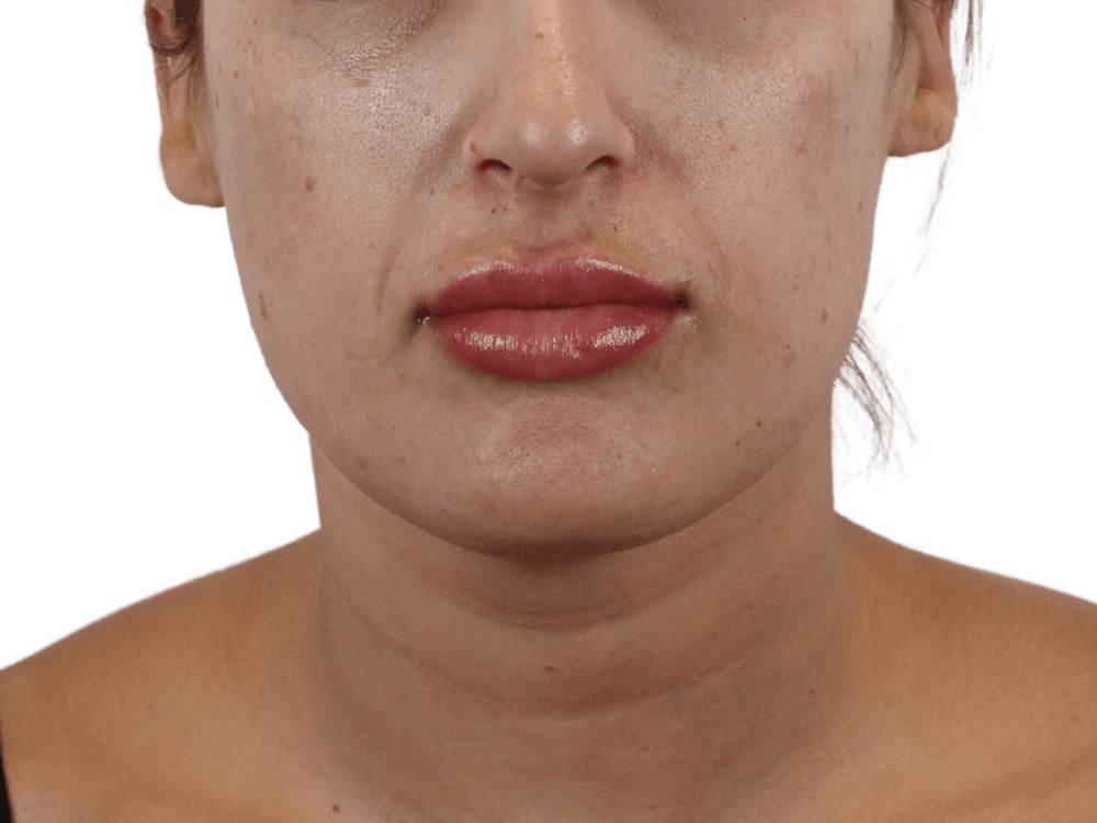 Lip Filler Before & After Gallery - Patient 159271097 - Image 2