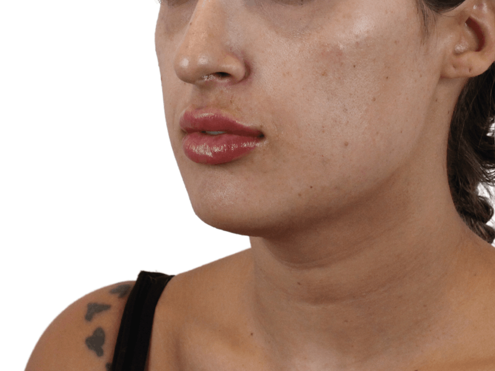Lip Filler Before & After Gallery - Patient 159271097 - Image 4