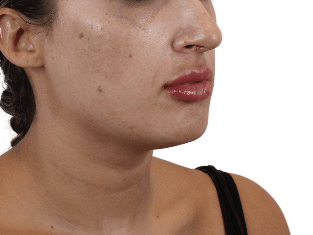 Lip Filler Before & After Gallery - Patient 159271097 - Image 6