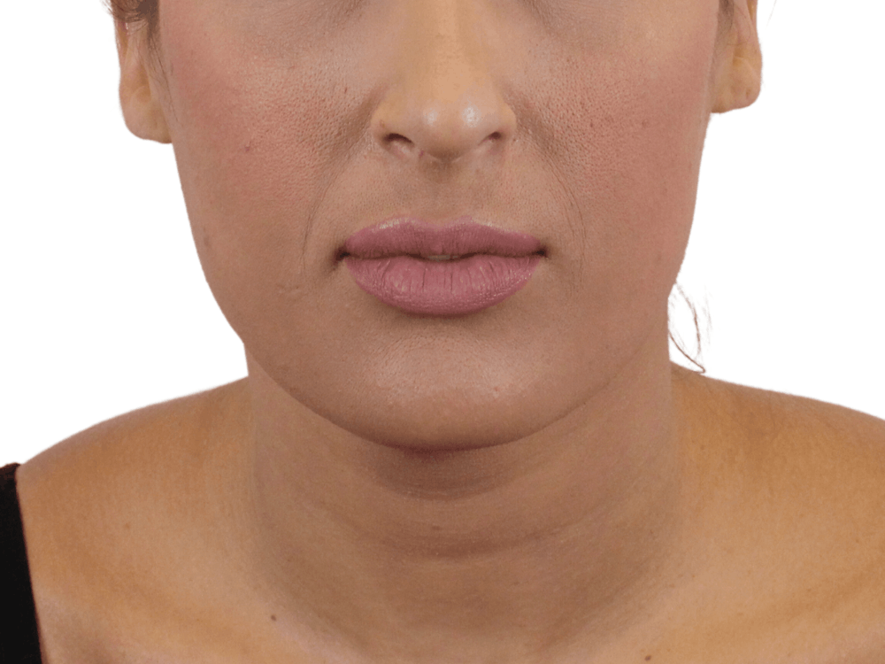 Lip Filler Before & After Gallery - Patient 159271097 - Image 1