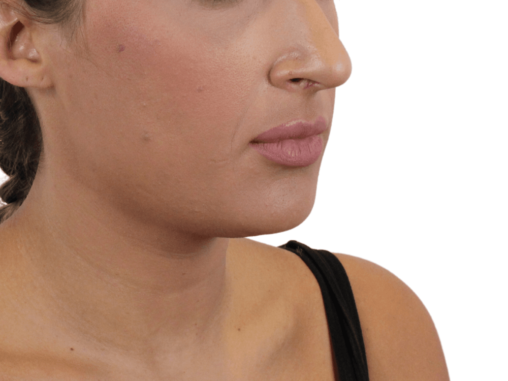 Lip Filler Before & After Gallery - Patient 159271097 - Image 5