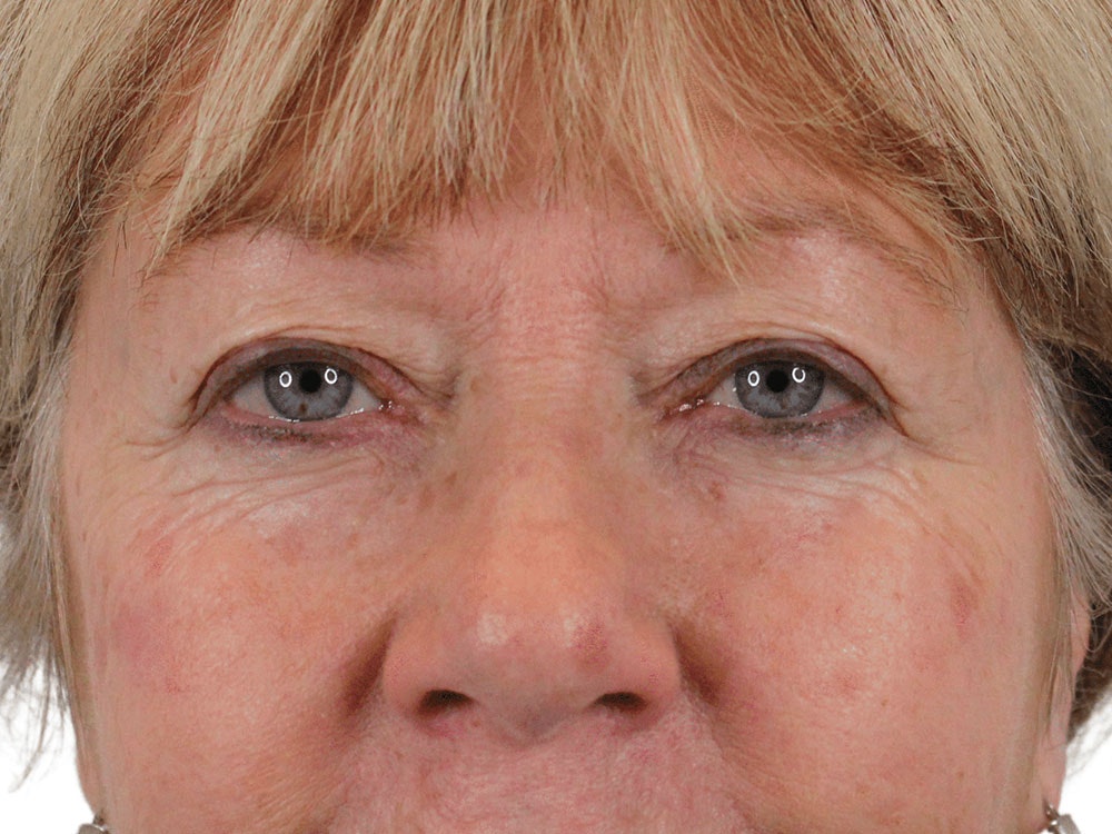 Blepharoplasty Before & After Gallery - Patient 162339203 - Image 1