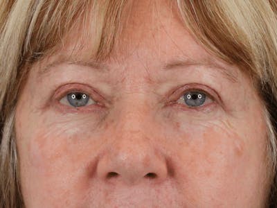 Blepharoplasty Before & After Gallery - Patient 162339203 - Image 2
