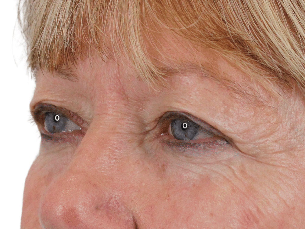 Blepharoplasty Before & After Gallery - Patient 162339203 - Image 3